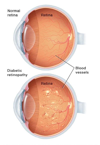 Retina